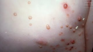 Molluscum Contagiosum PopTALK Dermatology diagnosis discussion [upl. by Eineg599]