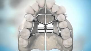 Surgically Assisted Palatal Expansion [upl. by Moritz]