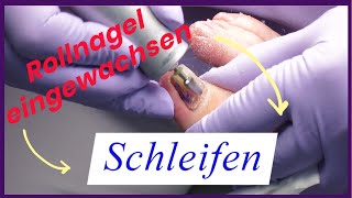 Rollnagel eingewachsen und dick  3 Tippsschleifenschneidentamponieren [upl. by Flip]