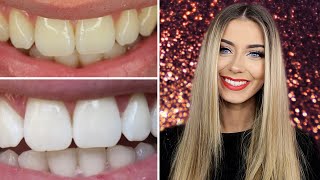 How I Whitened My Teeth at Home  Danielle Mansutti [upl. by Kovacs517]