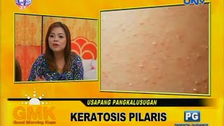 Keratosis Pilaris chicken skin [upl. by Enelym287]