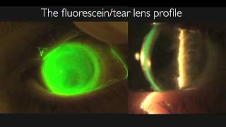 msd™ mini scleral lens presented by Dr Stephen P Byrnes OD Part 2Fitting [upl. by Lehcer]