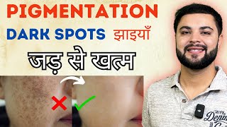 मुश्किल Pigmentation Dark Spots Melasma amp झाइयाँ जड़ से खत्म  100 Treatment [upl. by Omrellug]