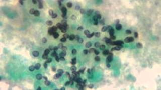 Pneumocystis pneumonia PCP [upl. by Enileuqkcaj]