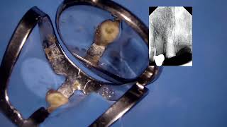 LiveEndo ¿Como es una Endodoncia Video Educativo [upl. by Erreipnaej]