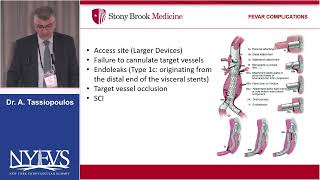 Management of short necks during EVAR Fenestrated vs Anchoring Apostolos Tassiopoulos Session I E [upl. by Gilli]