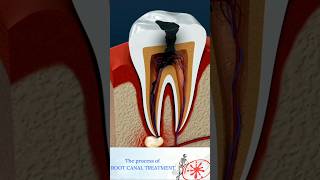 Root Canal Treatment Explained  How to Treat a Tooth Abscess Shorts [upl. by Moazami287]