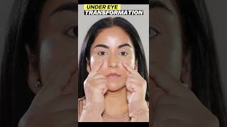 Transform YOUR Under Eye Hollow Instantly [upl. by Torr]