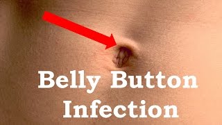 How to Treat Belly button Infection [upl. by Asilana32]