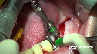 Dental Implantat Zahn 36 und 37 [upl. by Burkitt941]