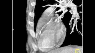 Vascular Diseased LAD 3D and 4D mapping of the coronary CT angiogram1 of 2 [upl. by Black216]