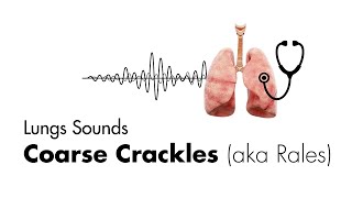 Coarse Crackles Rales  Lung Sounds  Medzcool [upl. by Karen]