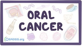 Oral Cancer  causes symptoms diagnosis treatment pathology [upl. by Reinar]