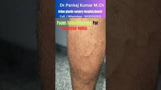 Foam Sclerotherapy treatment for varicose veins Varicose veins treatment before SSC GD medical [upl. by Neelra]