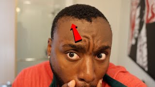 ITS HAPPENING MY HAIRLINE SURGERY IS WORKING [upl. by Rheingold187]