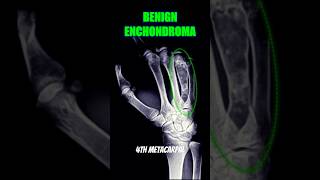 Enchondroma bones xray health [upl. by Bellanca305]