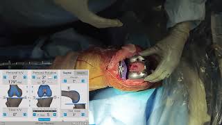 Measured Resection Approach in TKA with Joseph Locker MD [upl. by Hutchings]