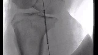 popliteal aneurysm [upl. by Onitnatsnoc]