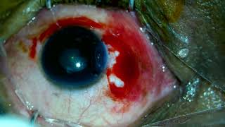 Pterygium Excision Autograft Cautery [upl. by Spence]