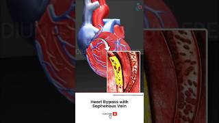 How Does Heart Bypass Surgery Work ↪ 3D Medical Animation Shorts SaphenousVein [upl. by Raddy199]