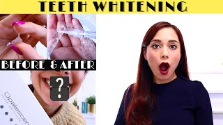 TEETH WHITENING BEFORE amp AFTER  OPALESCENCE 16 AT HOME KİT  HOW TO USE  SENSİTİVİTİES 🥴 [upl. by Bolger]