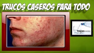 Como tratar la erupcion en la cara con remedios caseros naturales [upl. by Bashemath13]