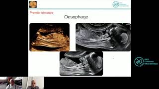 Tube Digestif Normal  Formation Echographie Obstétricale Maroc [upl. by Aslehc]