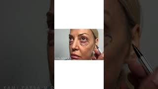 Lower Eyelid Blepharoplasty After Removing Tear Trough Filler  Dr Kami Parsa [upl. by Paske]