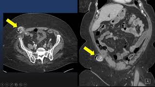 Imaging Abdominal wall and peritoneum [upl. by Jonina]