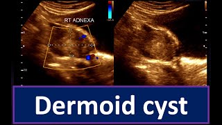 Understanding Dermoid Cyst  Guide to Ultrasonogram Diagnosis Ovarian Cyst  Practical Ultrasonogram [upl. by Amora345]