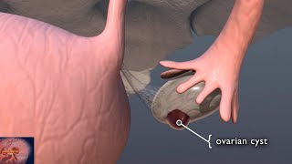 Ovarian Cysts 3D Animation  Ovarian Cysts Causes amp Treatment [upl. by Abroms]