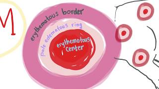 Erythema Multiforme with mnemonic  ALL you need to know [upl. by Porter]