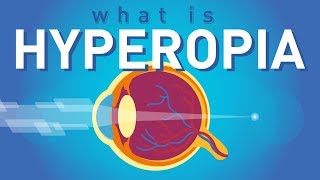 What is Hyperopia Farsightedness [upl. by Anilrac]