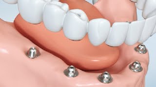 Remplacement de toutes les dents  prothèse fixe  le saviezvous [upl. by Aiela]