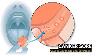 What is CANKER SORES Causes Signs and Symptoms Diagnosis and Treatment [upl. by Weiser895]