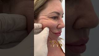 20 Years Back with Scarless Facelift by ProfDrSuleyman Tas facelift drsuleymantas [upl. by Heppman]