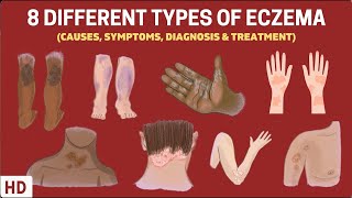 Eczema Exposed 8 Types You Need to Know [upl. by Isabel398]