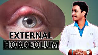 external hordeolum eyelid diseases external hordeolum case presentation 2021 [upl. by Schacker680]