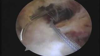 Arthroscopic Rotator cuff repair partial bursal side tear DrBancha Chernchujit [upl. by Orlene]