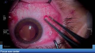 Retinal detachment due to retinoschisis Lukan Mishev Live Stream [upl. by Ness260]