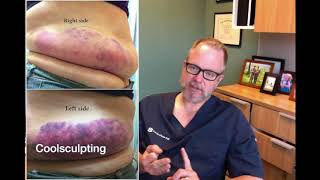 Sculpsure vs Coolsculpting  Which One is Better [upl. by Nedra]