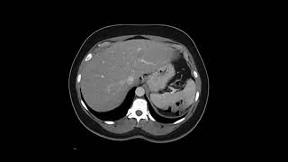 Retroperitoneal Leiomyosarcoma [upl. by Aysa]