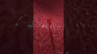 Bleeding gastric ulcer 3d animation anatomy meded [upl. by Uaeb]