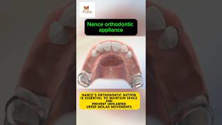 Nance Orthodontic Appliance  Braces  Orthodontics [upl. by Winonah]