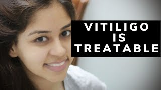 Hindi  Vitiligo treatment is possible know How [upl. by Fairbanks128]