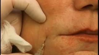 How to Lift Mouth Corners amp Marionettes With A Dermal Filler [upl. by Halimaj883]