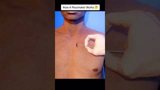 How a Pacemaker Works in Your Body health yourbody facts pacemaker heartmonitoring cardiac [upl. by Ocin]