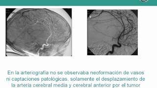 NeurorgsnetTumor cerebral de hemisferio derecho [upl. by Eneluqcaj]