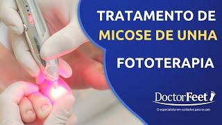 Tratamento de Micose de Unha com Laser  Fototerapia [upl. by Nnaeiluj889]