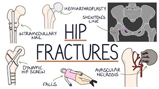 Understanding Hip Fractures and Hip Surgery [upl. by Giustina556]